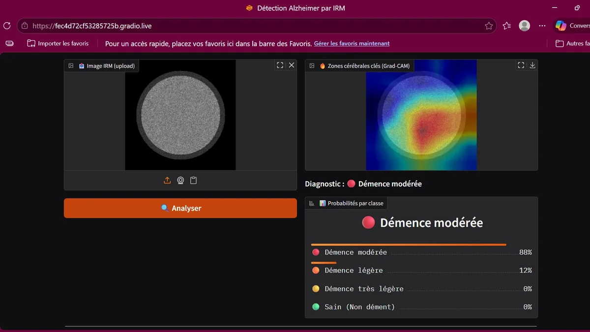 Système de détection et classification automatique de la Maladie d'Alzheimer via CNN